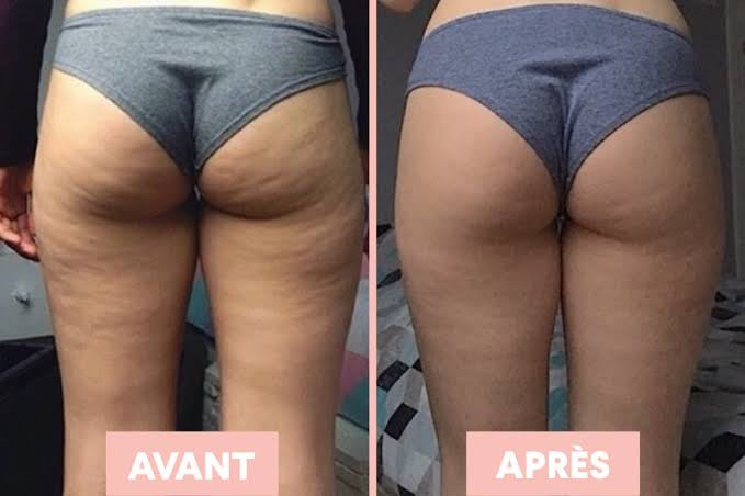 Dermaluxe – Appareil Anti-Cellulite