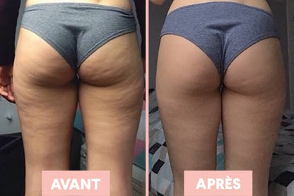 Dermaluxe – Appareil Anti-Cellulite