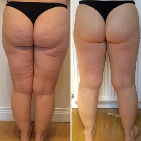 Avant après cellulite Dermaluxe